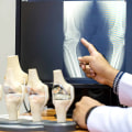 What is the success rate of stem cell therapy for knees?